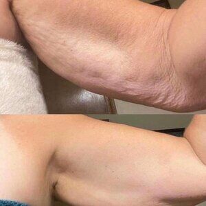 Body Contouring Gel